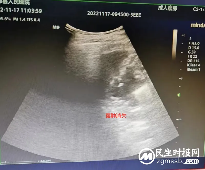 超微创!医院开展超声引导下肾囊肿穿刺硬化治疗术 超微创!医院开展超声引导下肾囊肿穿刺硬化治疗术