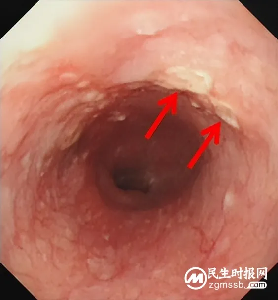 不开刀,治早癌!这项技术被称为消化道早癌的克星 不开刀,治早癌!这项技术被称为消化道早癌的克星