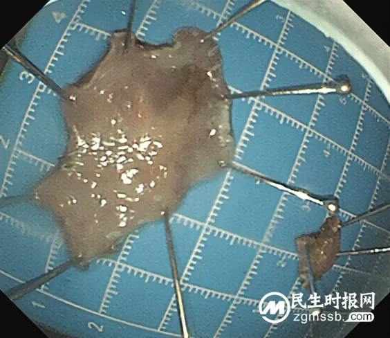 不开刀,治早癌!这项技术被称为消化道早癌的克星 不开刀,治早癌!这项技术被称为消化道早癌的克星