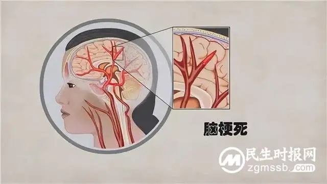 替罗非班抗血小板--急性脑梗死治疗的新选择