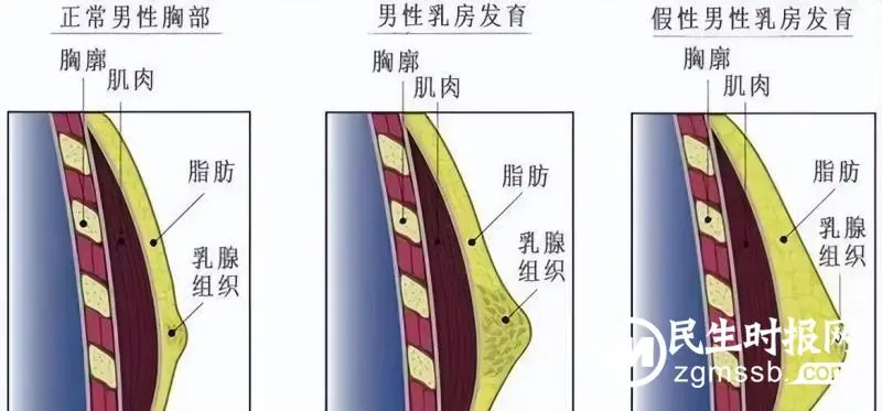 年轻小伙成“大胸弟” 男性乳腺健康不容忽视 年轻小伙成“大胸弟” 男性乳腺健康不容忽视