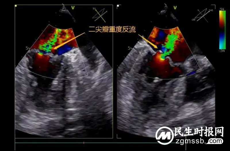 【中心医院·医者红】“心”动力,新突破! 湘潭市中心医院完成我市首例经导管二尖瓣缘对缘修复术 【中心医院·医者红】“心”动力,新突破! 湘潭市中心医院完成我市首例经导管二尖瓣缘对缘修复术