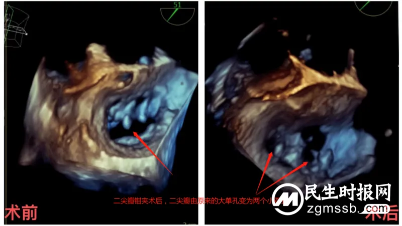 【中心医院·医者红】“心”动力,新突破! 湘潭市中心医院完成我市首例经导管二尖瓣缘对缘修复术 【中心医院·医者红】“心”动力,新突破! 湘潭市中心医院完成我市首例经导管二尖瓣缘对缘修复术
