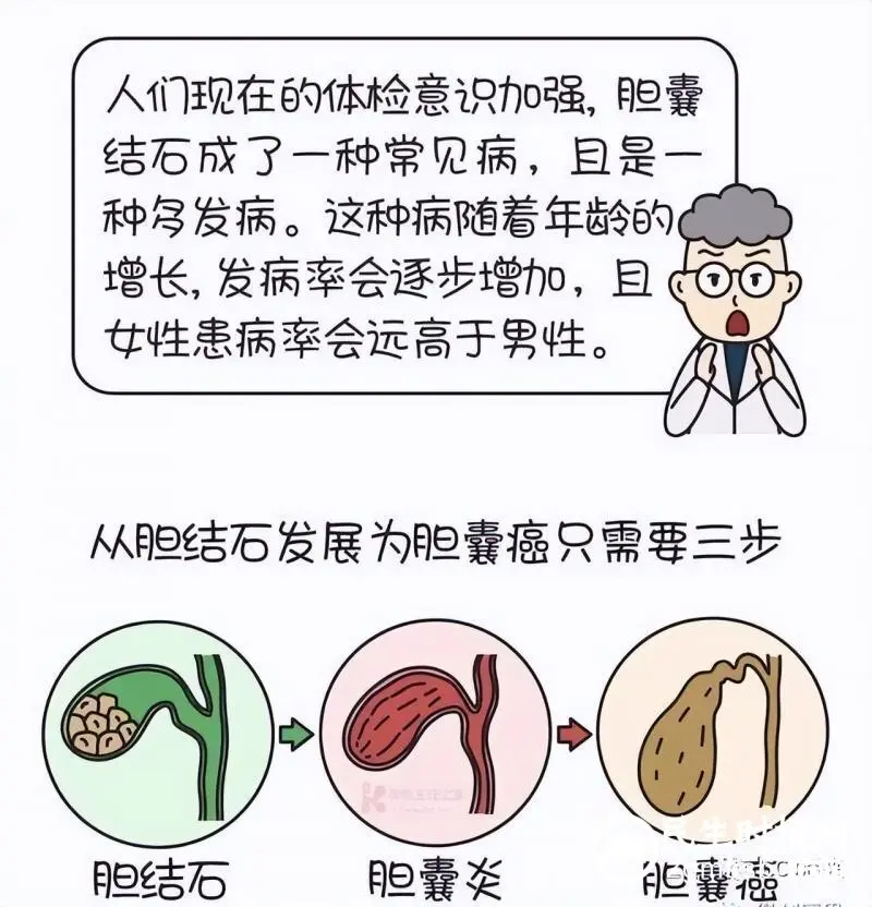 体检查出胆结石,胆囊到底切不切? 体检查出胆结石,胆囊到底切不切?