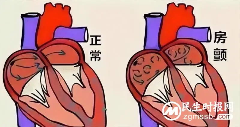【中心医院·医者红】湘潭首例!脉冲电场消融术为房颤患者带来新的福音 【中心医院·医者红】湘潭首例!脉冲电场消融术为房颤患者带来新的福音