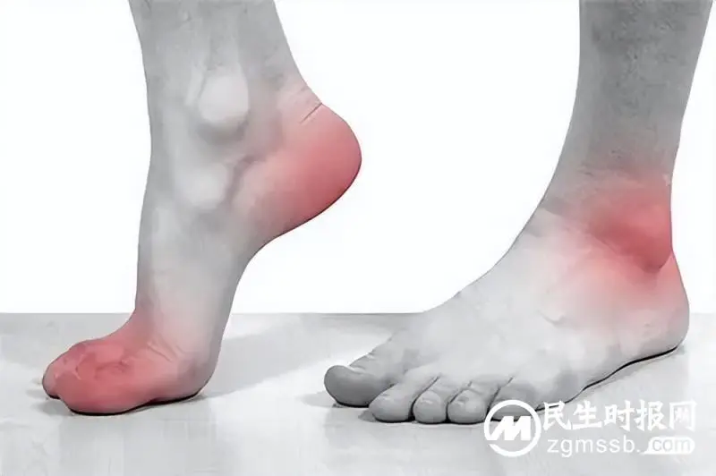 得了痛风怎么办? 得了痛风怎么办?