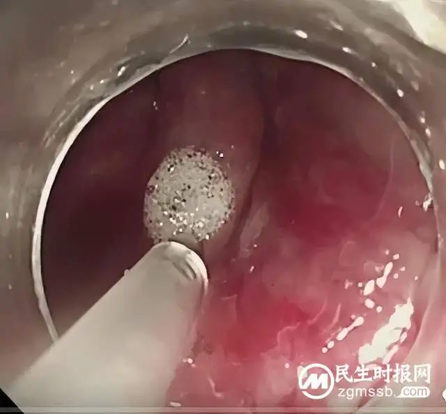 久“痔”不愈怎么办？微创治疗来帮您！