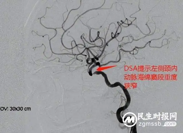 【中心建设】再获好评！湘潭县人民医院卒中中心团队连续完成两例颈内动脉支架植入术