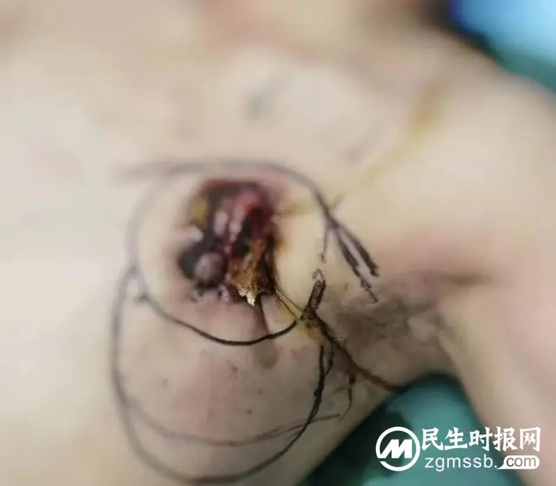 乳腺癌晚期可以活多久?医生忠告:积极抗癌,可以达到满意疗效 乳腺癌晚期可以活多久?医生忠告:积极抗癌,可以达到满意疗效