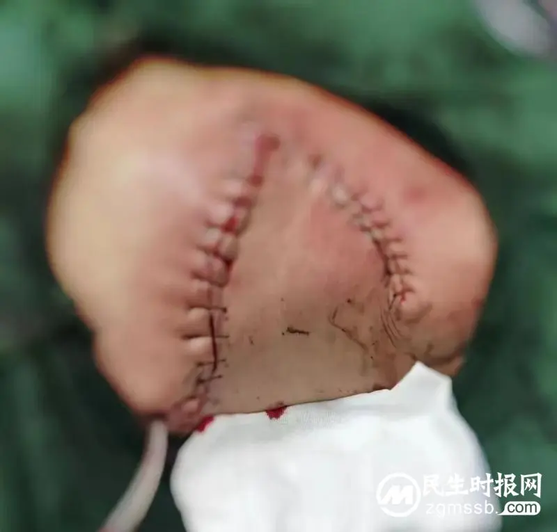 乳腺癌晚期可以活多久?医生忠告:积极抗癌,可以达到满意疗效 乳腺癌晚期可以活多久?医生忠告:积极抗癌,可以达到满意疗效