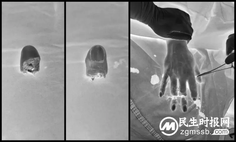 两人手指被离断,“微雕大师”显神通! 两人手指被离断,“微雕大师”显神通!