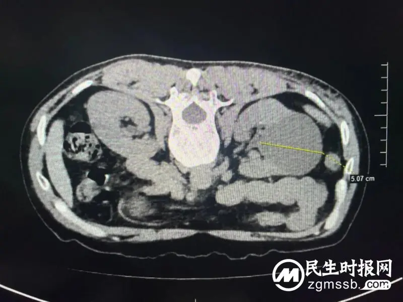 啥？用一根针就把手术做了！