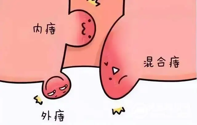久“痔”不愈怎么办？微创治疗来帮您！