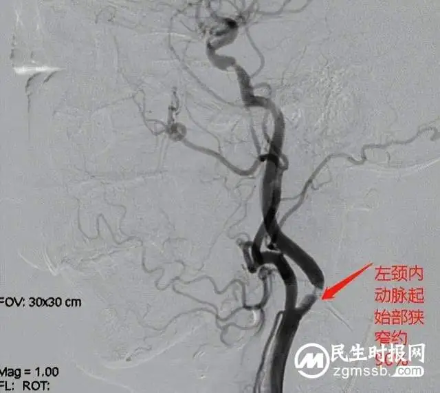 【中心建设】再获好评！湘潭县人民医院卒中中心团队连续完成两例颈内动脉支架植入术