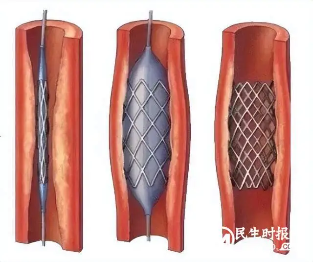 【中心建设】再获好评！湘潭县人民医院卒中中心团队连续完成两例颈内动脉支架植入术