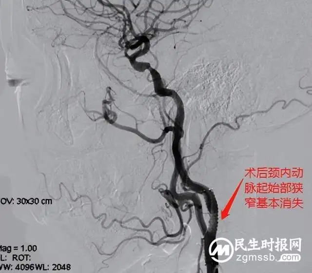 【中心建设】再获好评！湘潭县人民医院卒中中心团队连续完成两例颈内动脉支架植入术