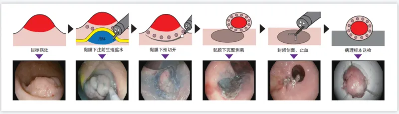 用这项技术，不开刀也能治消化道早癌