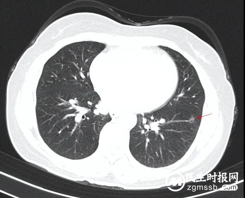 体检发现肺结节怎么办？听听医生怎么说