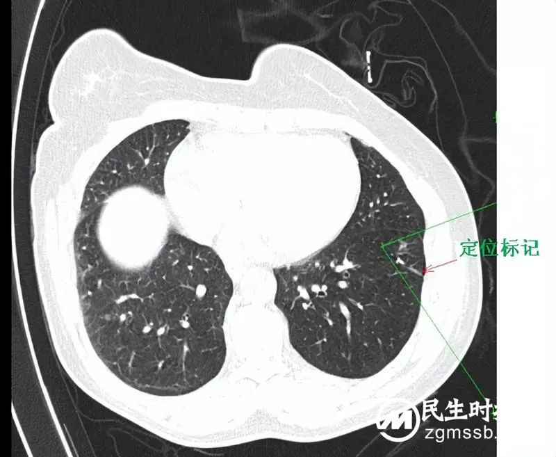 体检发现肺结节怎么办？听听医生怎么说