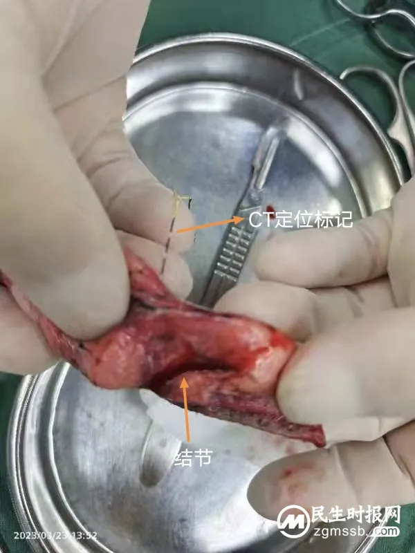 体检发现肺结节怎么办？听听医生怎么说