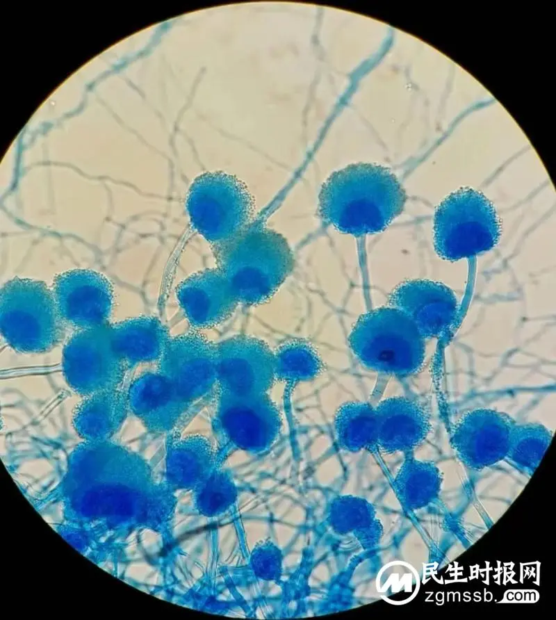 食物会长霉,你见过人也会“长霉”吗? 食物会长霉,你见过人也会“长霉”吗?