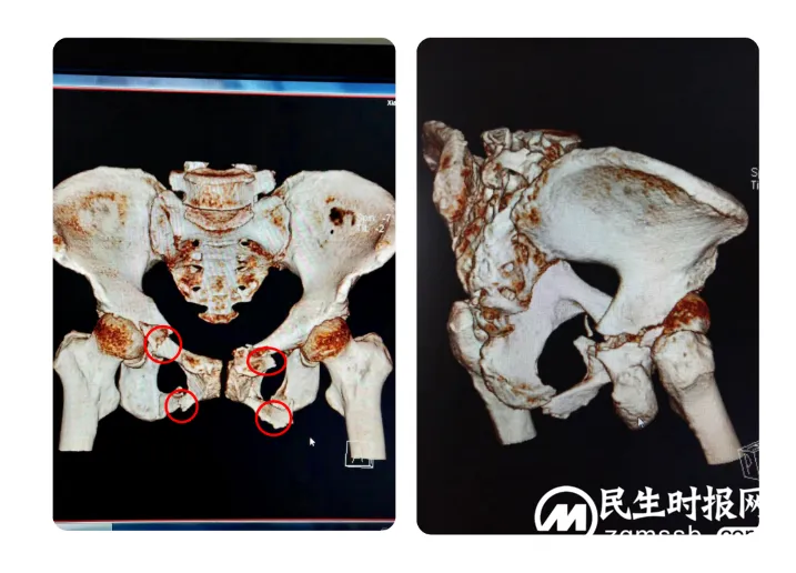 【骨科创新】——湘潭县中医医院骨一科完成首例髋臼T型骨折、骨盆多发骨折开放复位钢板及桥接内固定术 【骨科创新】——湘潭县中医医院骨一科完成首例髋臼T型骨折、骨盆多发骨折开放复位钢板及桥接内固定术