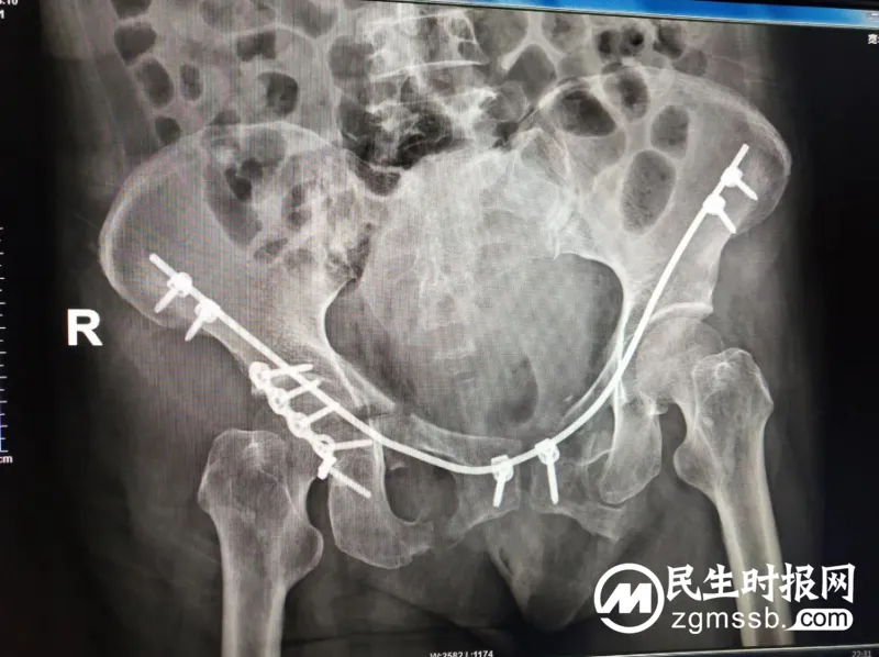 【骨科创新】——湘潭县中医医院骨一科完成首例髋臼T型骨折、骨盆多发骨折开放复位钢板及桥接内固定术 【骨科创新】——湘潭县中医医院骨一科完成首例髋臼T型骨折、骨盆多发骨折开放复位钢板及桥接内固定术