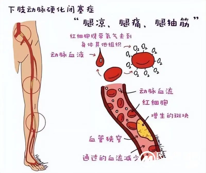 糖尿病足合并下肢动脉硬化闭塞又添治疗新技术！
