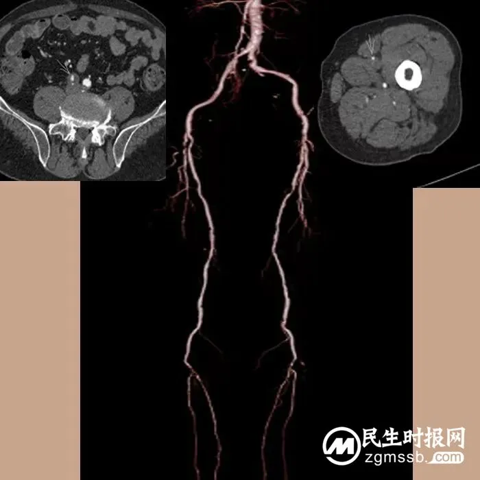 糖尿病足合并下肢动脉硬化闭塞又添治疗新技术！
