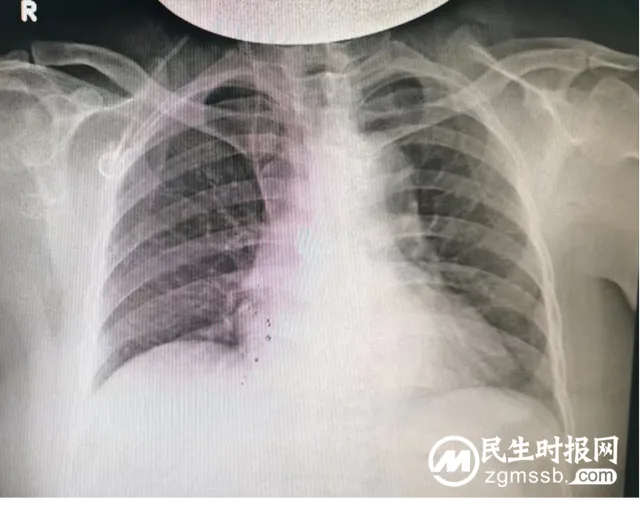【卓越医疗】静脉输液港植入术--重铸化疗患者“生命线”