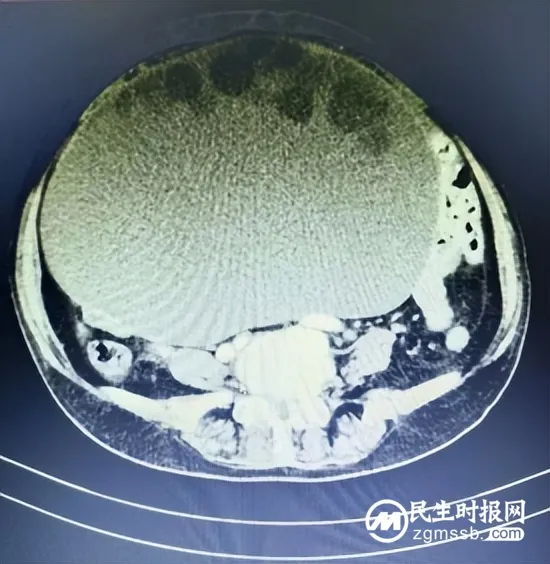 【耄耋老媪“怀孕”,普外医生“接生” 】——湘潭县中医医院普外科团队为高龄巨大腹部肿块患者保驾护航 【耄耋老媪“怀孕”,普外医生“接生” 】——湘潭县中医医院普外科团队为高龄巨大腹部肿块患者保驾护航