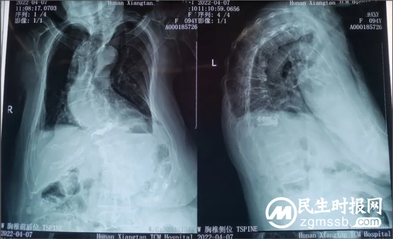 【中医•医者红】卓越服务丨九旬高龄腰背痛,微创术后变轻松 【中医•医者红】卓越服务丨九旬高龄腰背痛,微创术后变轻松