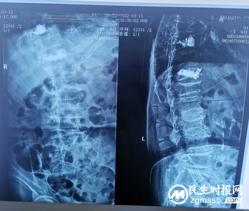 【中医•医者红】卓越服务丨九旬高龄腰背痛,微创术后变轻松 【中医•医者红】卓越服务丨九旬高龄腰背痛,微创术后变轻松
