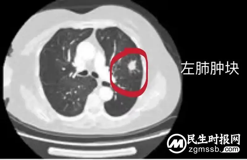【惠景科普】体检发现肺癌，射频消融根治