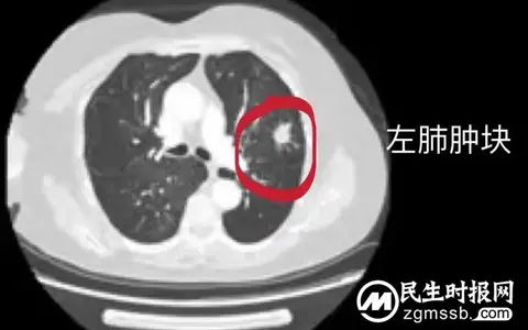 【惠景科普】体检发现肺癌，射频消融根治
