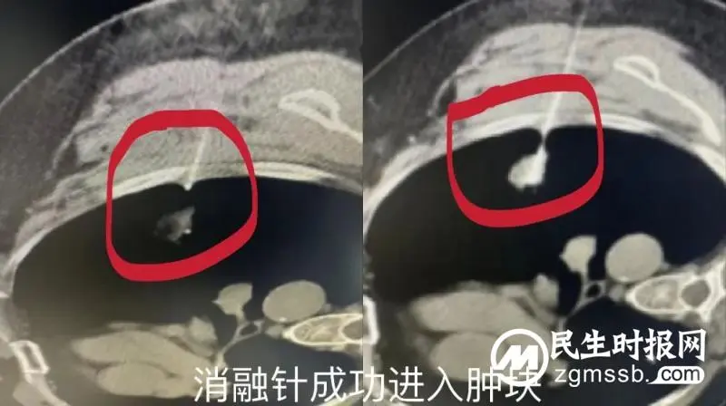 【惠景科普】体检发现肺癌，射频消融根治