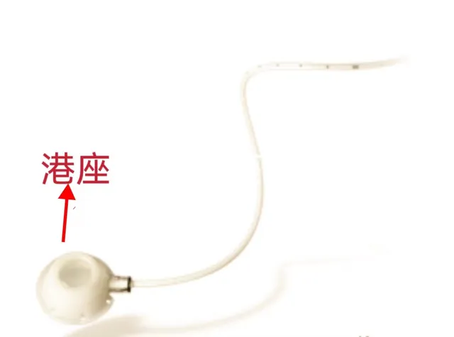 【卓越医疗】静脉输液港植入术--重铸化疗患者“生命线”