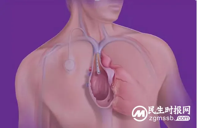 【卓越医疗】静脉输液港植入术--重铸化疗患者“生命线”