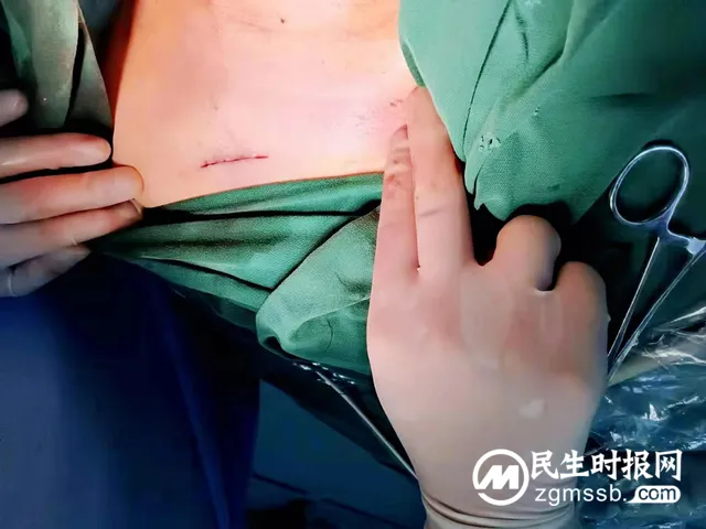 【卓越医疗】静脉输液港植入术--重铸化疗患者“生命线”