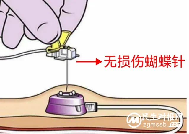 【卓越医疗】静脉输液港植入术--重铸化疗患者“生命线”