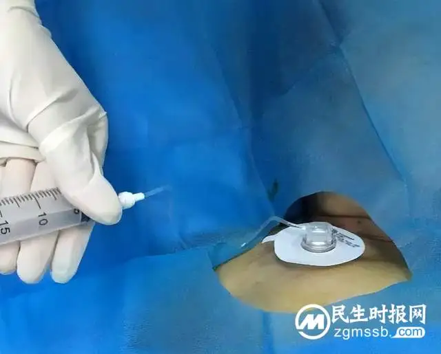 【卓越医疗】静脉输液港植入术--重铸化疗患者“生命线”