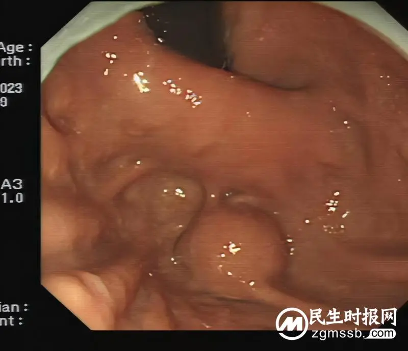 【关爱生命】远离消化道早癌，早筛查是关键