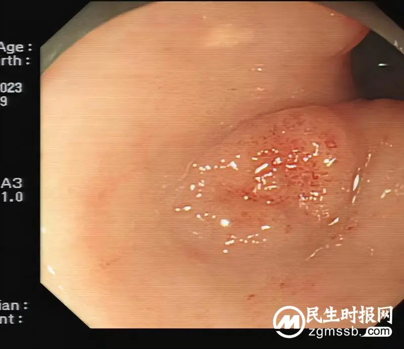 【关爱生命】远离消化道早癌，早筛查是关键