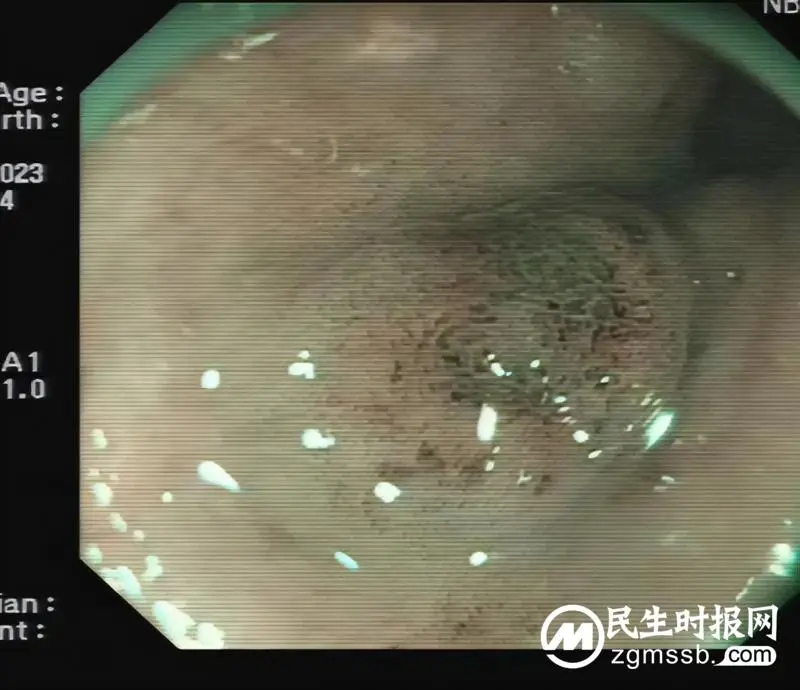 【关爱生命】远离消化道早癌，早筛查是关键