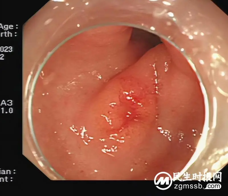 【关爱生命】远离消化道早癌，早筛查是关键