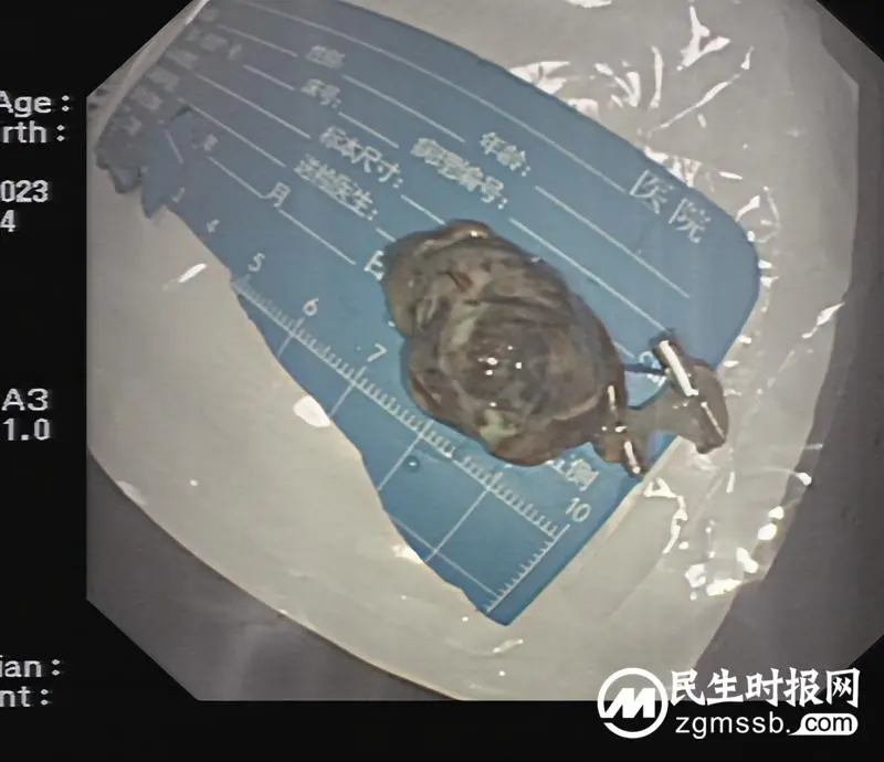 【关爱生命】远离消化道早癌，早筛查是关键