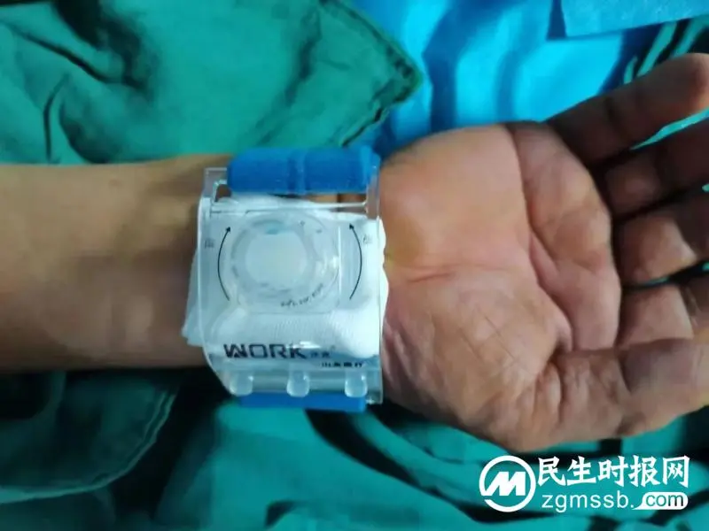 新突破!湘潭市首例经桡动脉入路行脑血管病介入治疗成功开展! 新突破!湘潭市首例经桡动脉入路行脑血管病介入治疗成功开展!