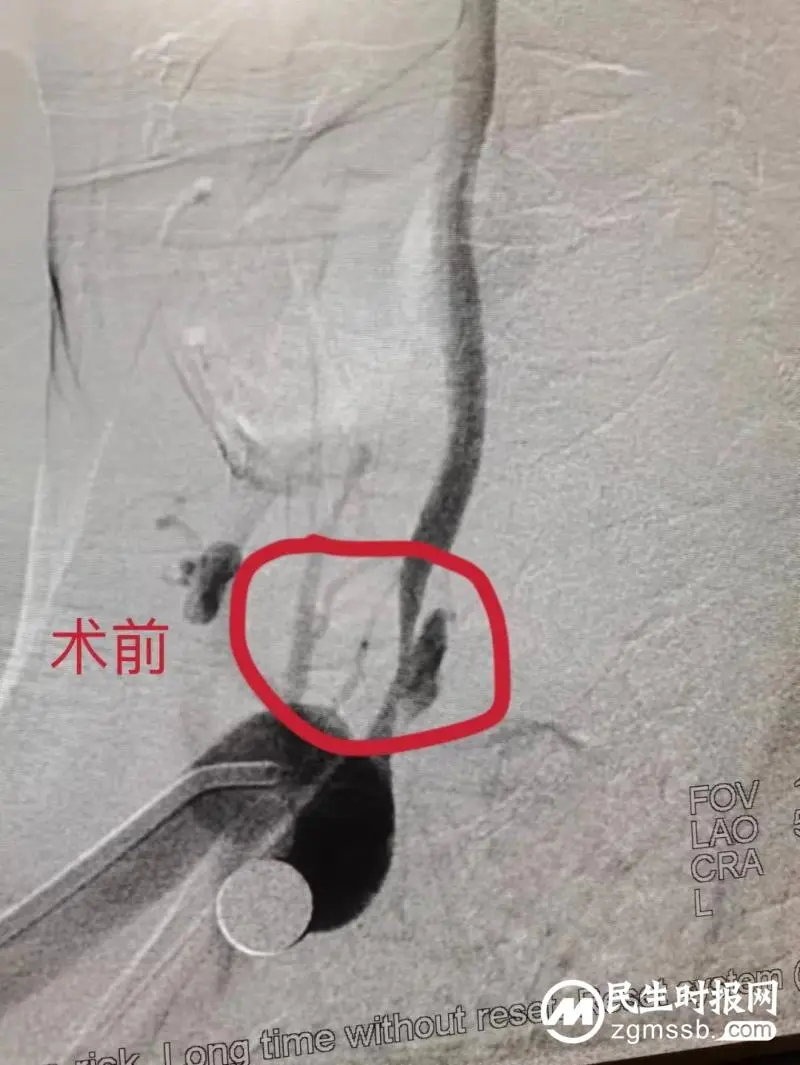 新突破!湘潭市首例经桡动脉入路行脑血管病介入治疗成功开展! 新突破!湘潭市首例经桡动脉入路行脑血管病介入治疗成功开展!