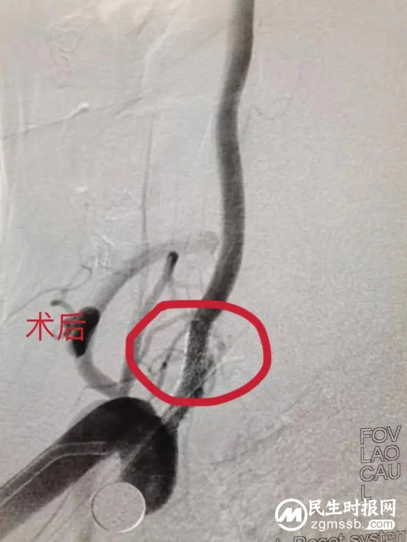 新突破!湘潭市首例经桡动脉入路行脑血管病介入治疗成功开展! 新突破!湘潭市首例经桡动脉入路行脑血管病介入治疗成功开展!