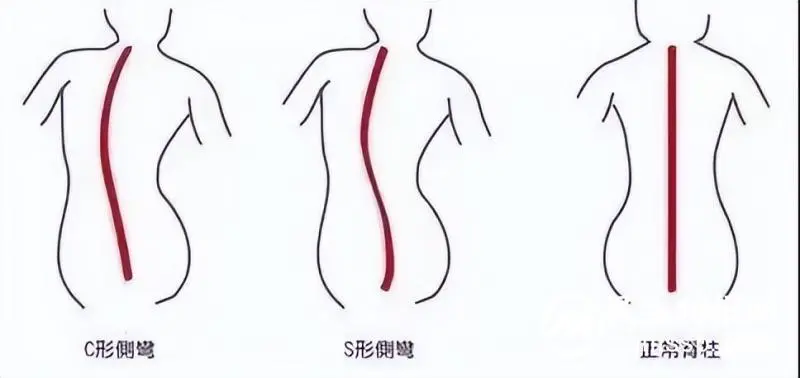 湘潭县中医医院脊柱侧弯筛查开始啦! 湘潭县中医医院脊柱侧弯筛查开始啦!